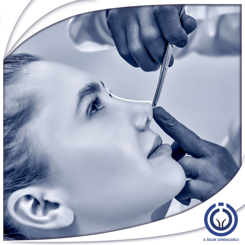 ESTETİK BURUN OPERASYONU (RİNOPLASTİ)